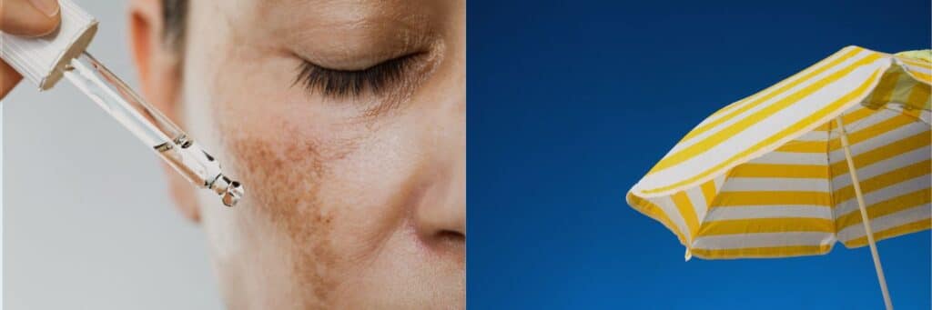 Hyperpigmentering, pigmentpletter og leverpletter