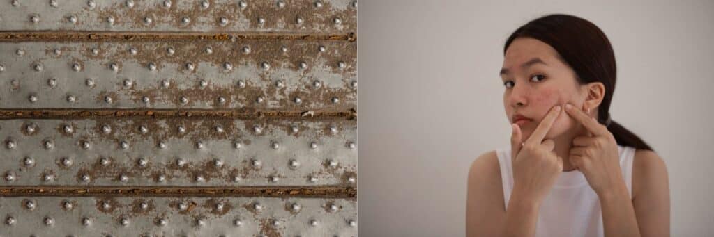 Tilstoppede porer, hvide knopper eller sorte hudorme? Læs artiklen hos MIHO