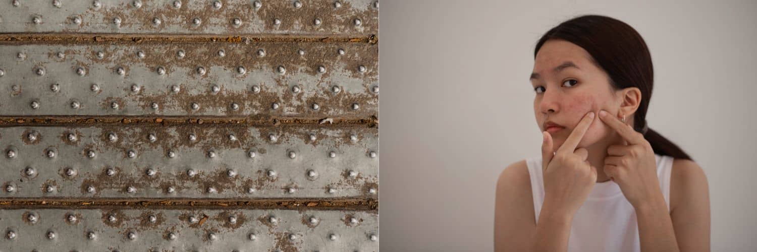 Tilstoppede porer, hvide knopper eller sorte hudorme?